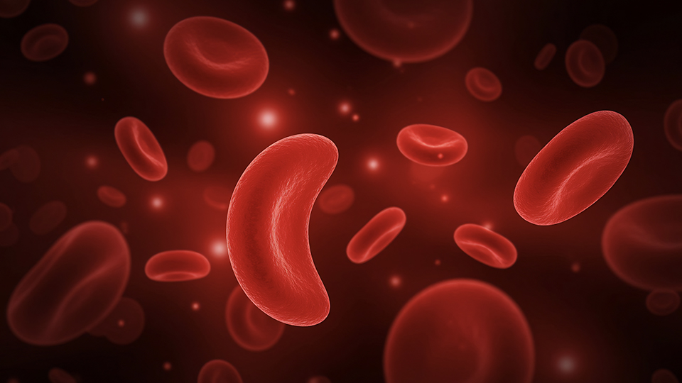 Image RFE Drépanocytose