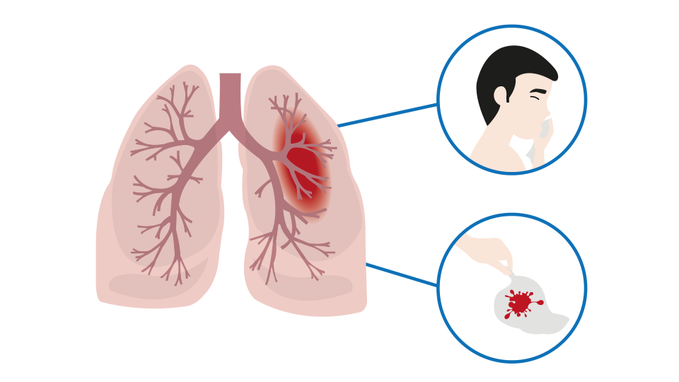 Кровь в легких причины