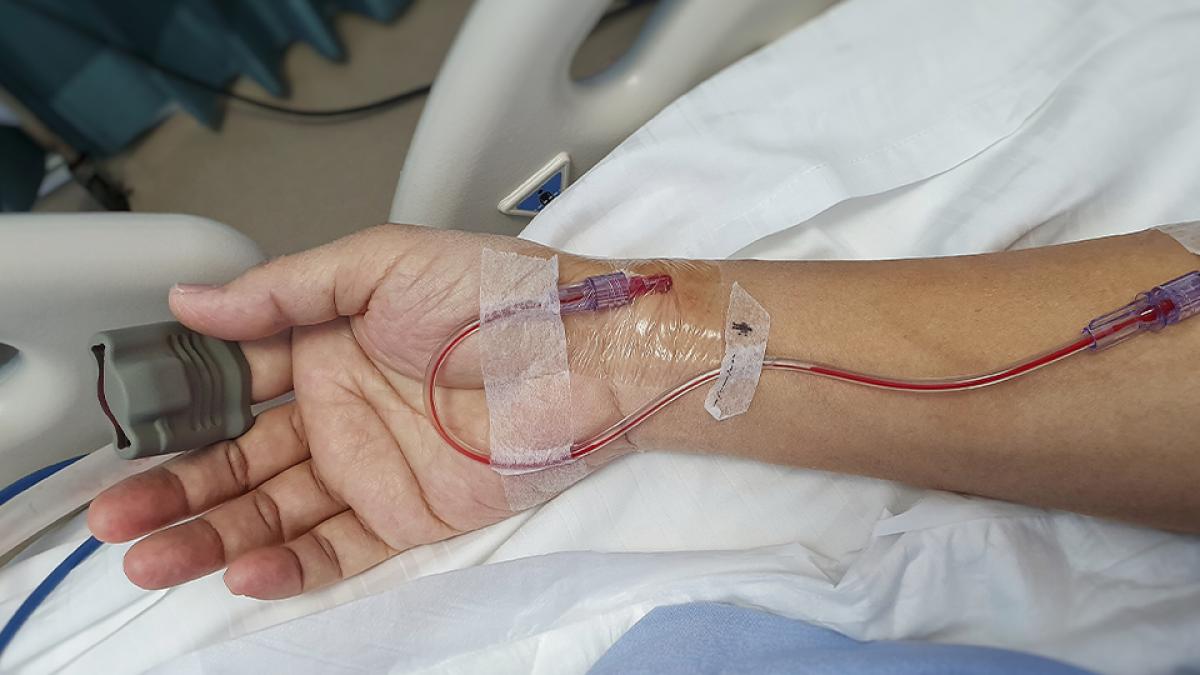 Le cathéter artériel radial dysfonctionne c’est le plus souvent l