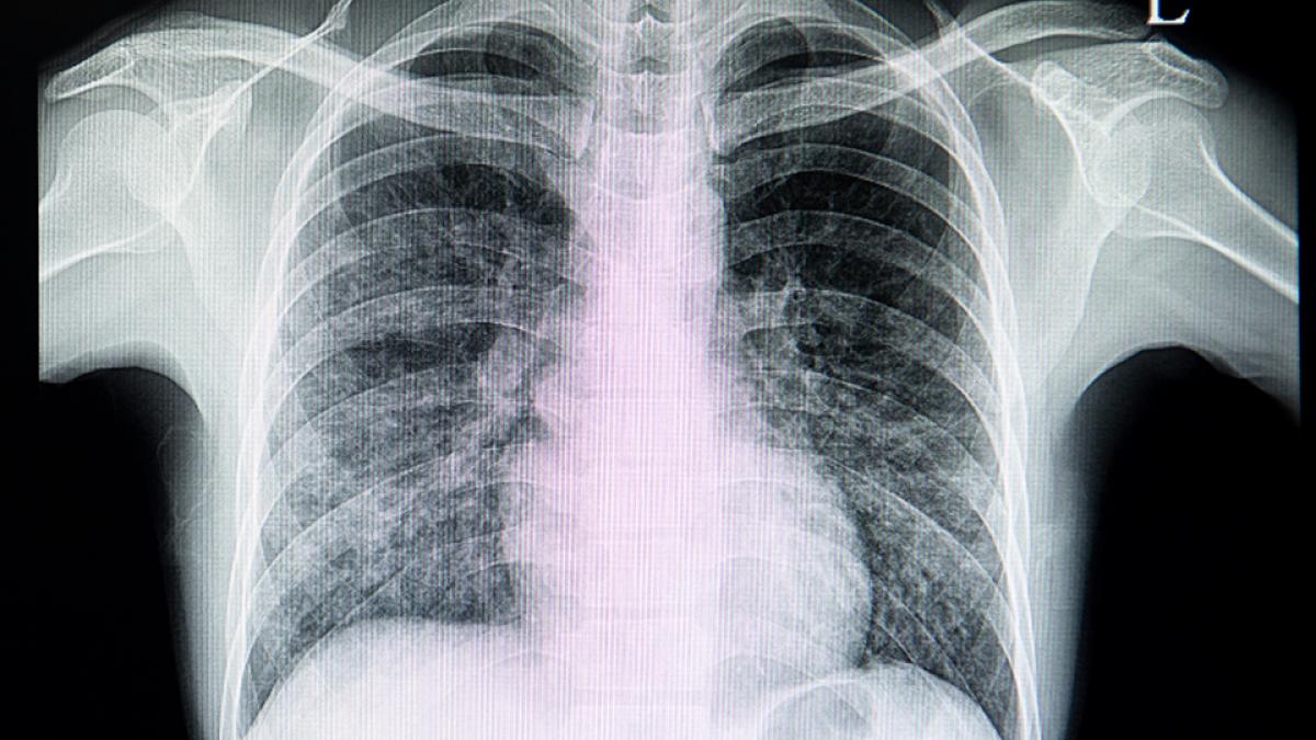 Pneumopathie D'inhalation Combien De Temps Apres Fausse Route Pneumopathie interstitielle diffuse et insuffisance respiratoire aiguë