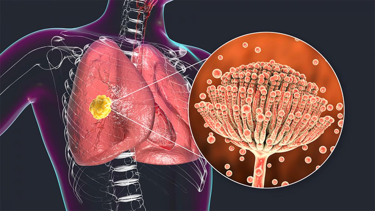 Infections fongiques invasives et Covid19 SRLF