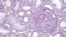 microangiopathie-thrombotique