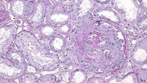 microangiopathie-thrombotique