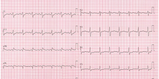 20160811-REACTU-Image-Rep_ECG1