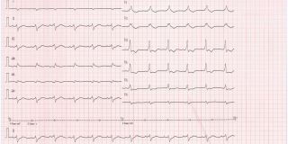 20160811-REACTU-Image-Rep_ECG2