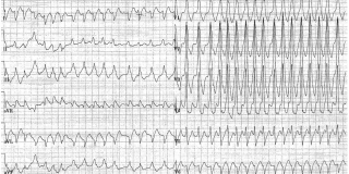 20160811-REACTU-Image-Rep_ECG4